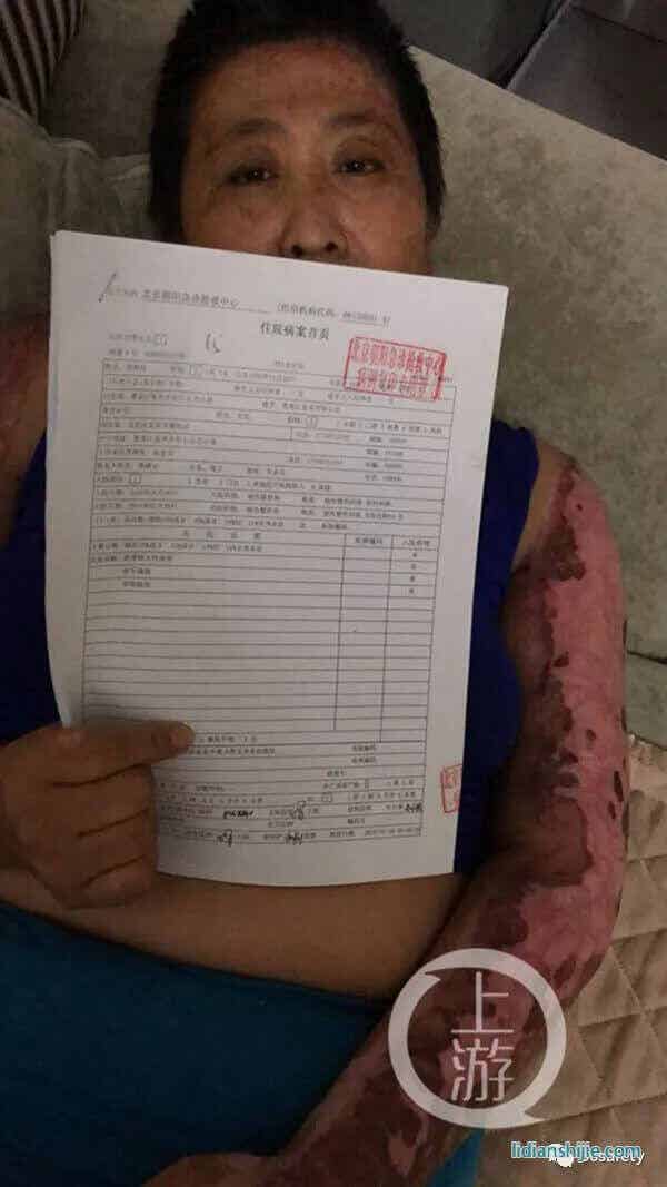 爆燃的電動(dòng)車鋰電池傷害